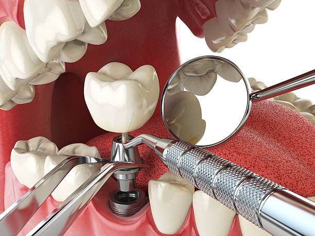 Best Emergency Root Canal Treatment in De Motte, IN